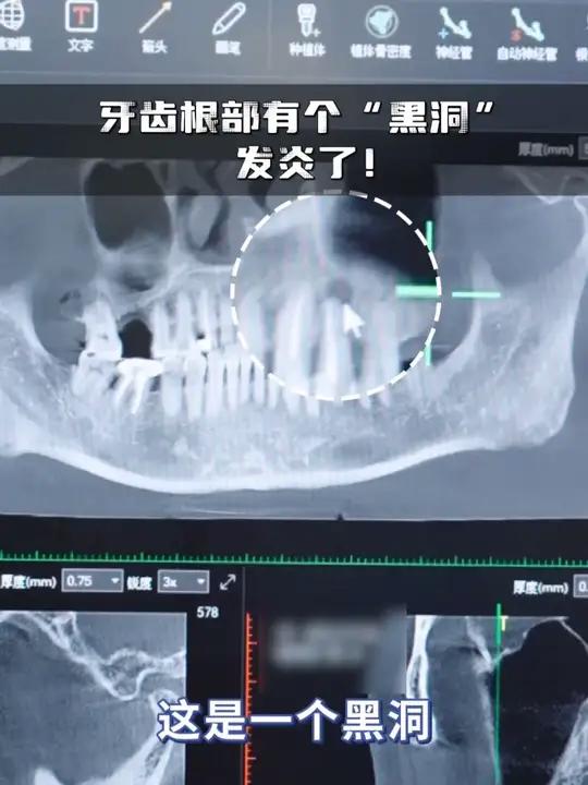 牙齿根部有个“黑洞”,发炎了!