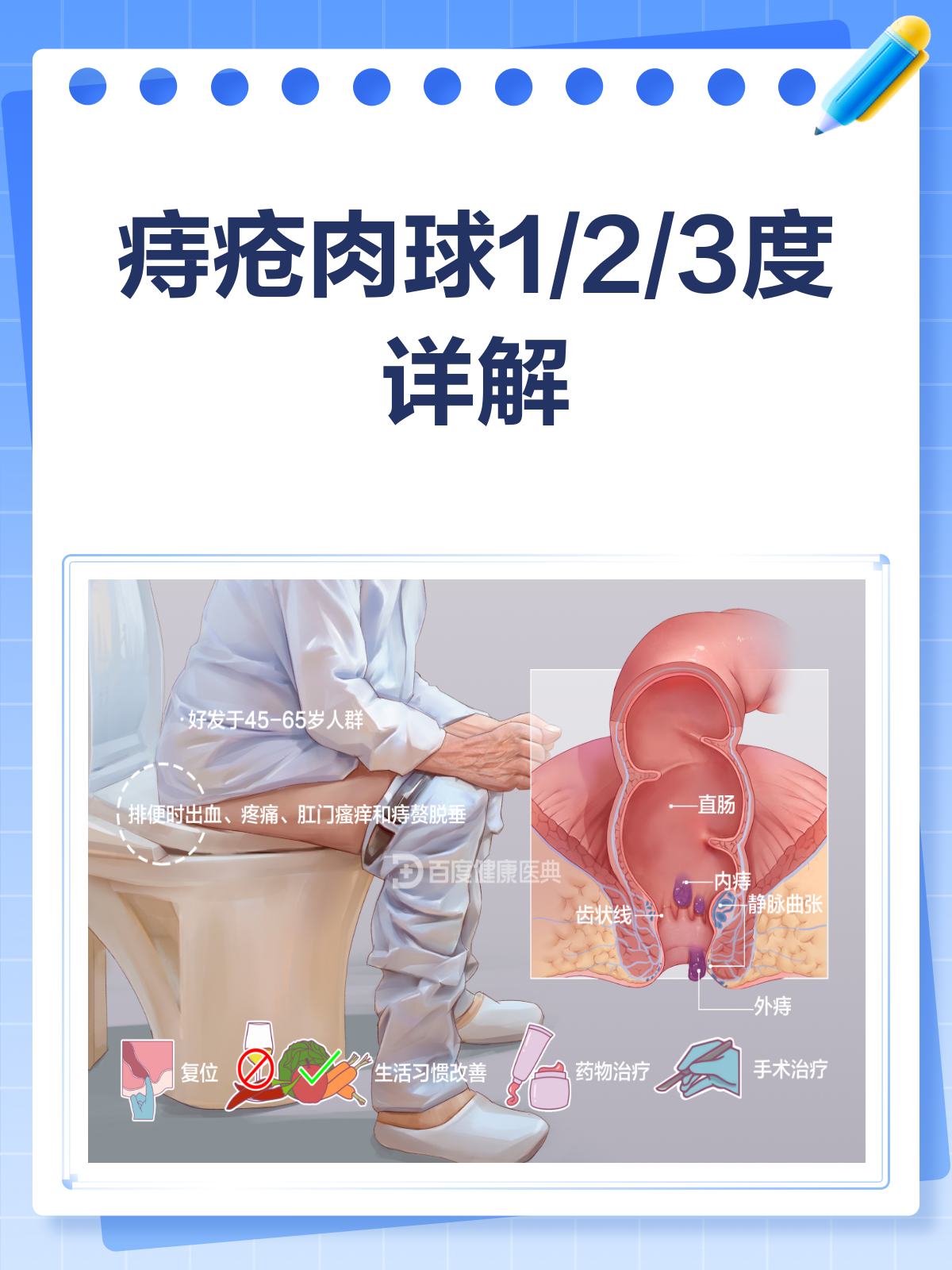 痔疮肉球分度图解,一看就懂!