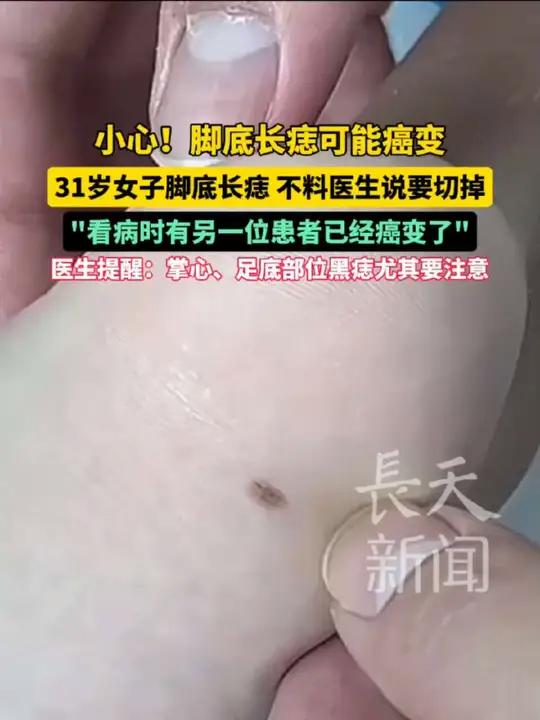 小心!脚底长痣可能癌变 31岁女子脚底长痣 不料医生说要切掉 “看病时有另一位患者已经癌变