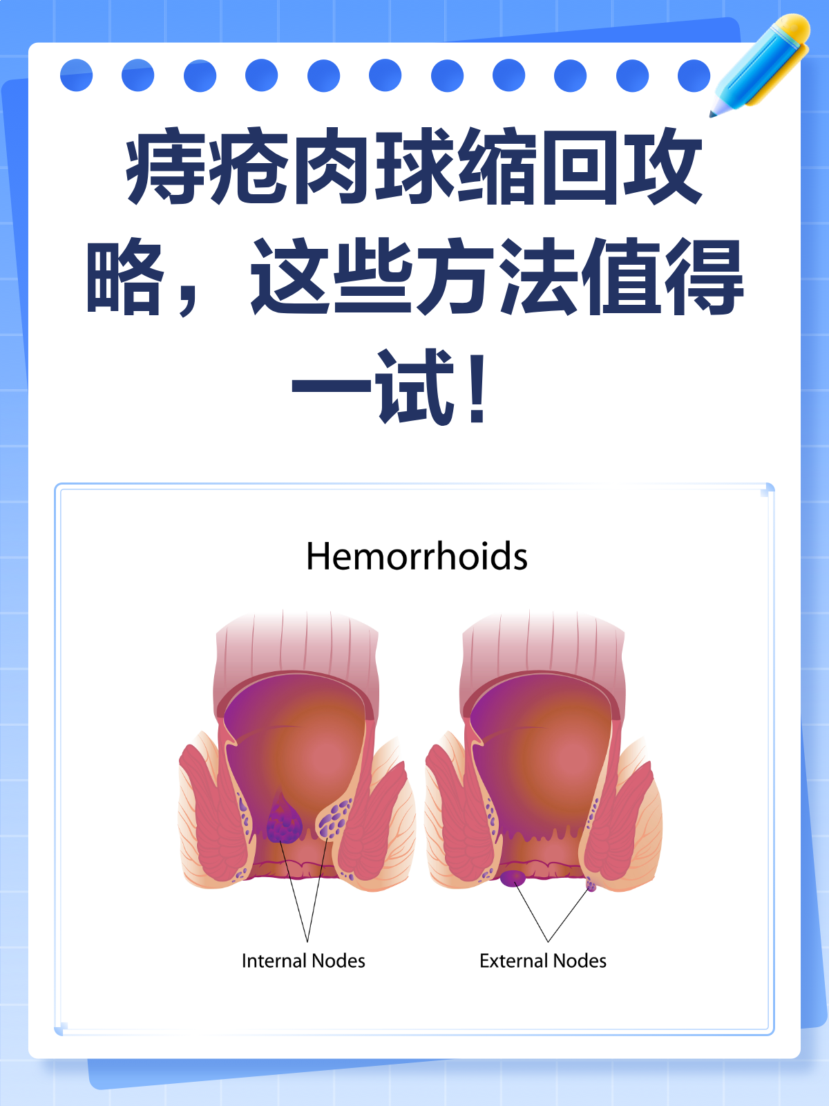 痔疮肉球难回缩?这几招助你轻松搞定!