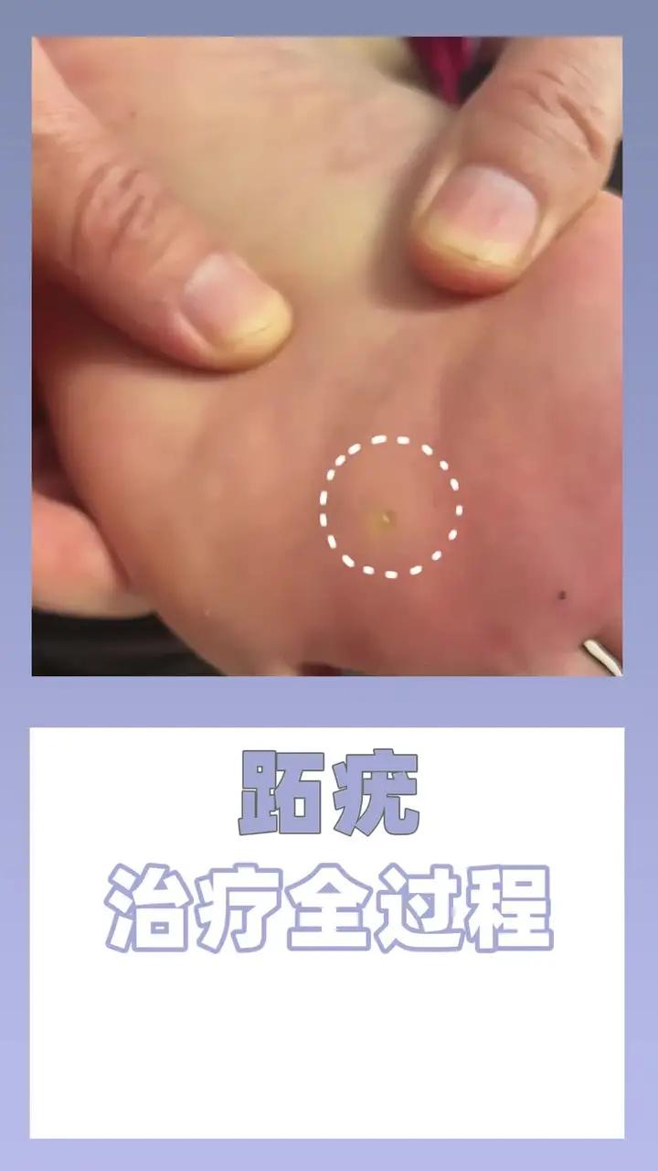 这不是鸡眼 脚底长了这种小疙瘩 不痛不痒的 中间还能看到一些小黑点 这是跖疣 hpv病毒感
