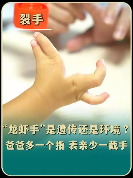 先天畸形“龙虾手”到底是遗传还是环境因素照成的?爸爸说自己说多指,孩子的表亲是缺肢!