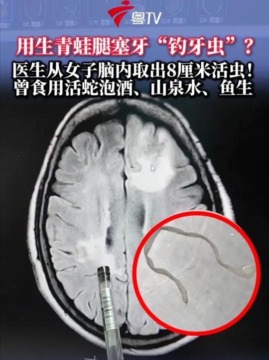 用生青蛙腿塞牙“钓牙虫” 医生从女子脑内取出8厘米活虫!曾食用活蛇泡酒、山泉水、鱼生