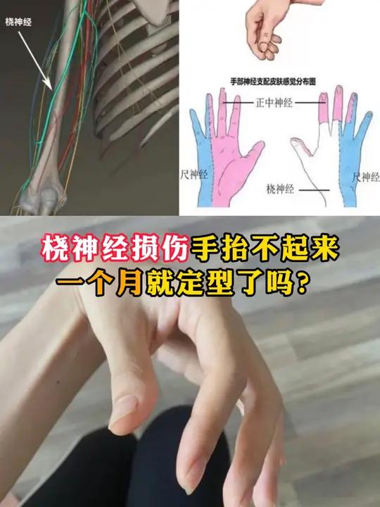 大家好,我是手及上肢外科高医生,今天来给桡神经损伤的患者讲讲,损伤到底多久能恢复的问题。咱