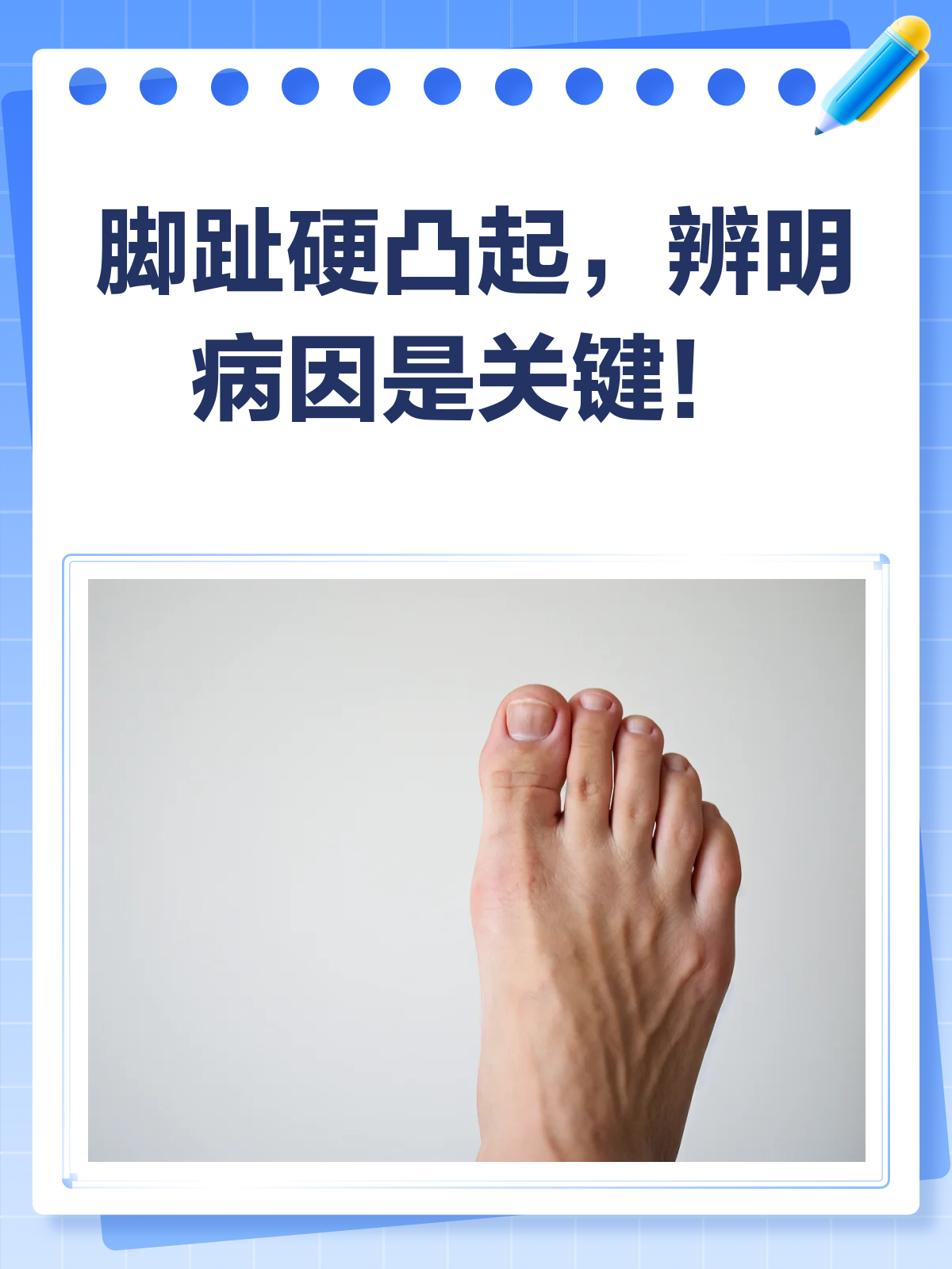 脚趾上的硬凸起?揭秘跖疣、鸡眼还是啥?