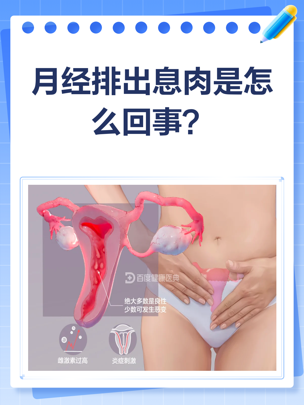 月经排出息肉?别慌,先了解这些!