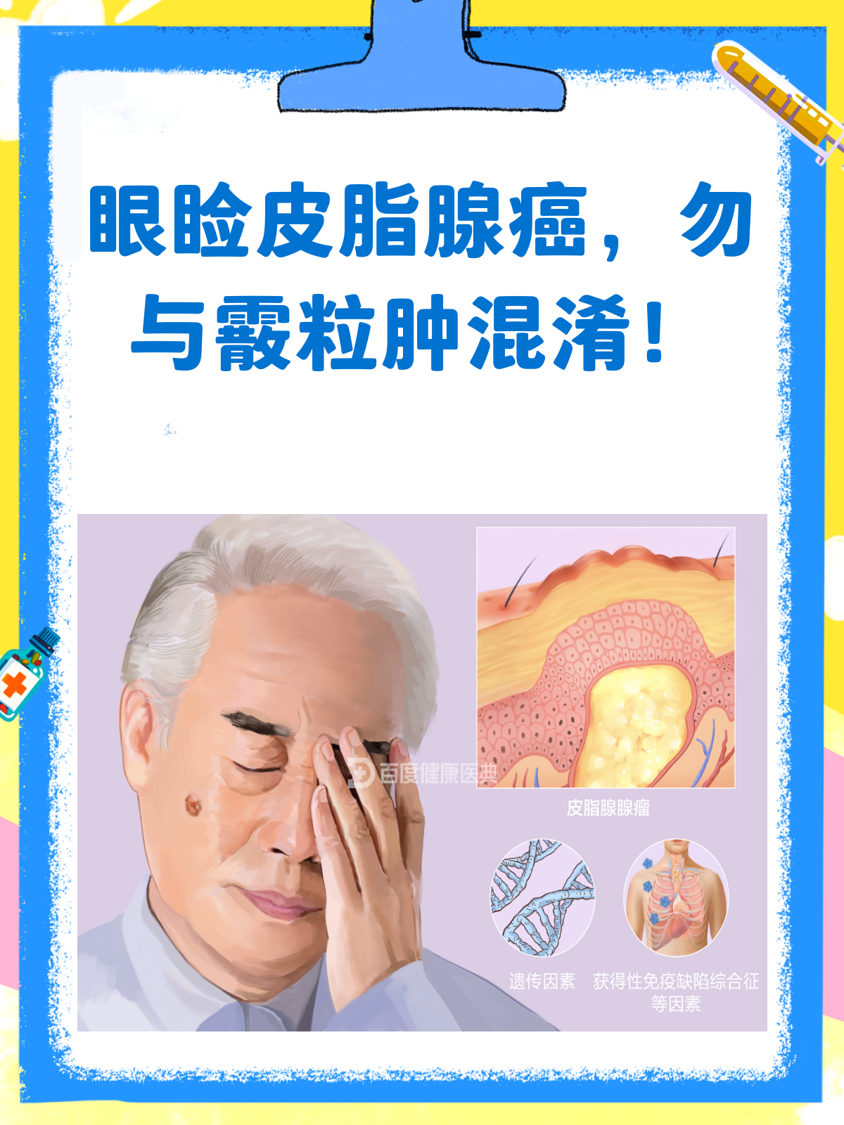 眼睑上的小疙瘩,竟是皮脂腺癌?别误诊了!