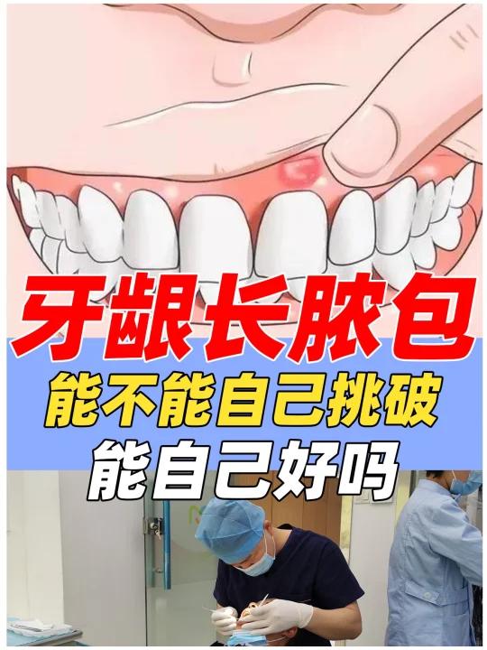 牙龈长脓包能不能自己挑破,怎么办?