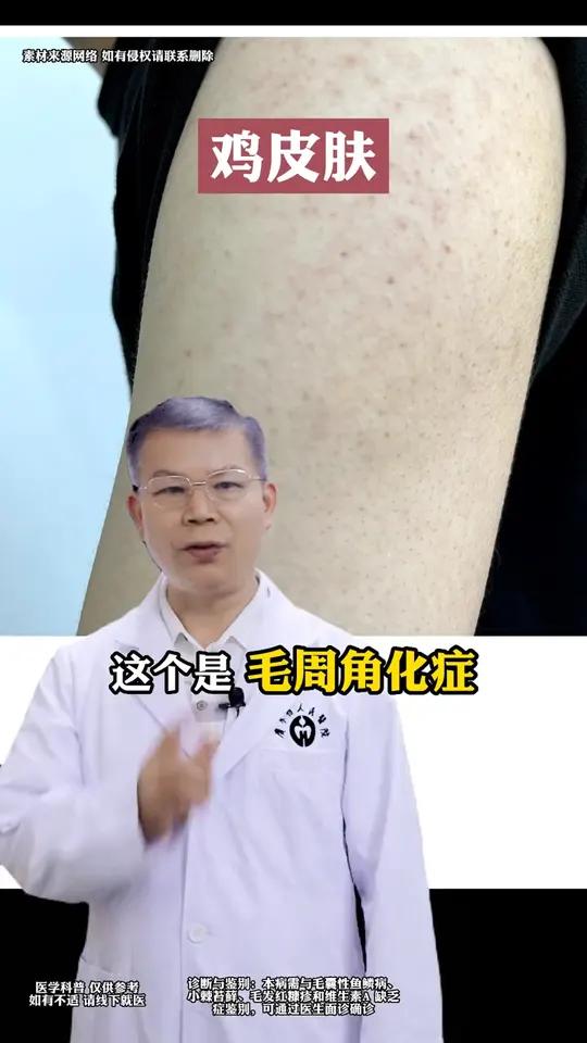 50%的人都有!胳膊腿上鸡皮肤疙疙瘩瘩到底怎么办?皮肤科医生教你正确处理