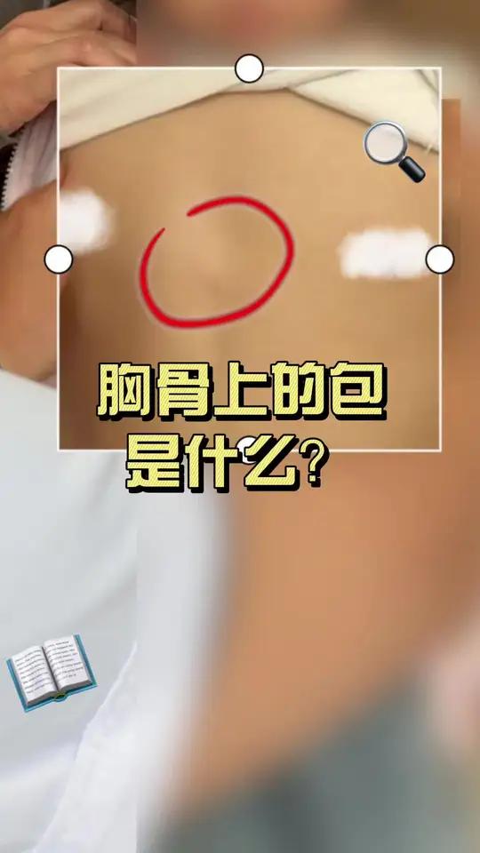 胸骨上的包是什么？#软骨瘤 #鸡胸 #健康科普破圈计划 #抖出健康知识宝藏 #儿童胸外科李