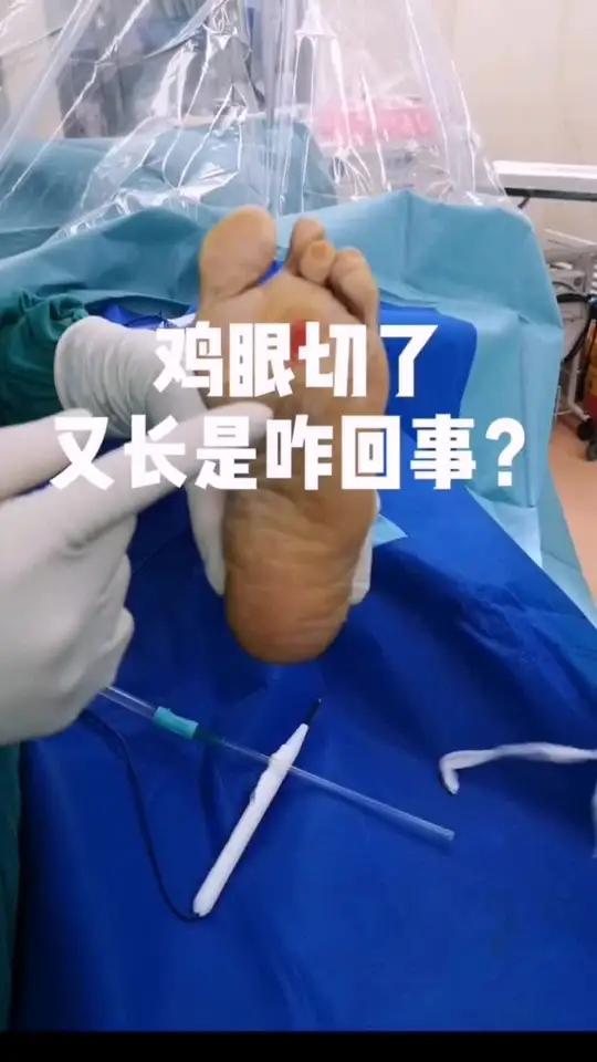 鸡眼切了又长,像割韭菜一样。如果做到不切就消失,听谢医生怎么说