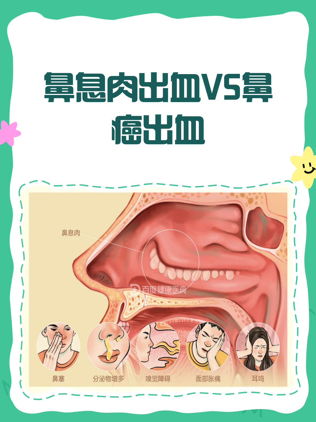 鼻息肉出血VS鼻癌出血,一文教你辨清楚!