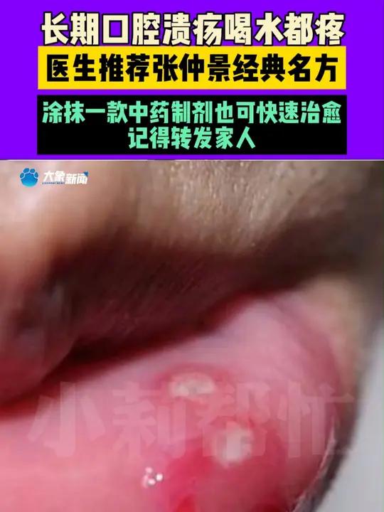 长期口腔溃疡喝水都疼,医生推荐张仲景经典名方,涂抹一款中药制剂也可快速治愈,记得转发家人。