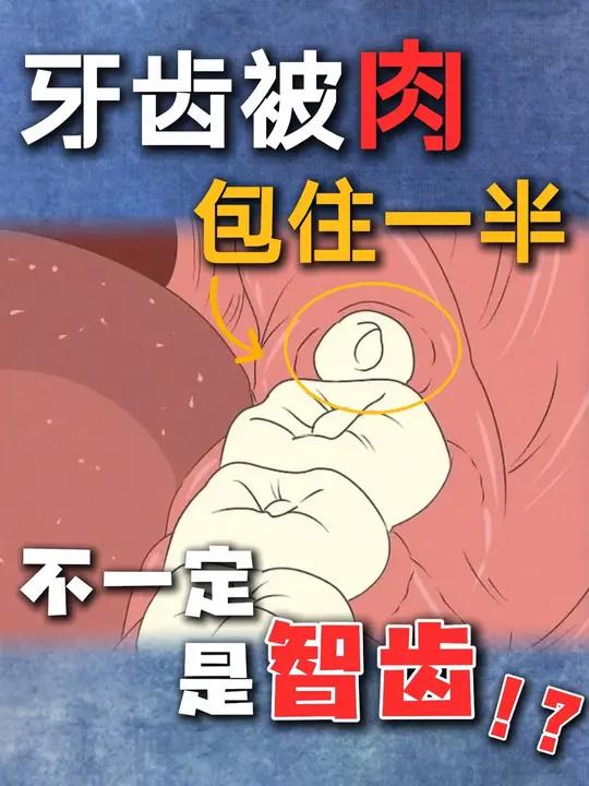 不是所有被肉包住的牙齿,都是智齿!
