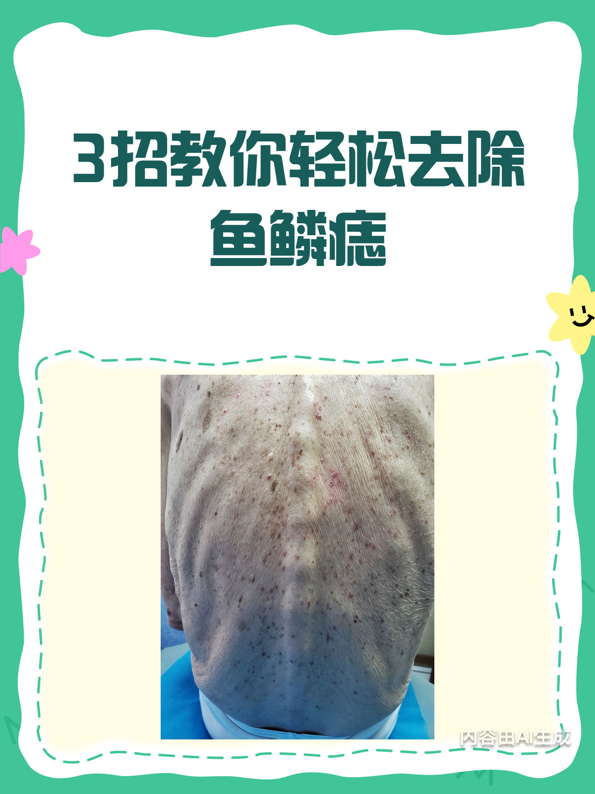 3招轻松去除鱼鳞痣,皮肤恢复光滑不是梦!