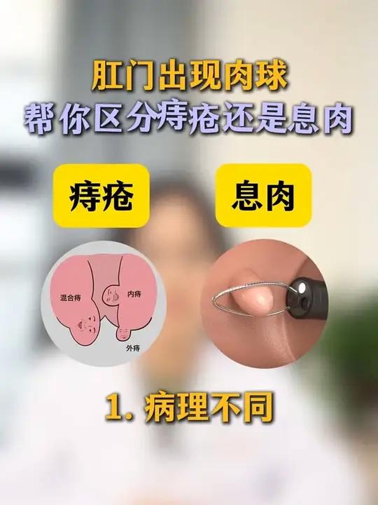 肛门出现肉球,教你区分痔疮还是息肉 #痔疮 #内痔 #外痔