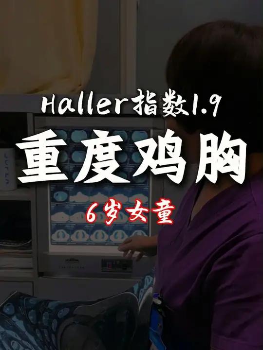 6岁的小女孩,重度鸡胸,但是还小,矫正器矫正。鸡胸 重度鸡胸 健康科普