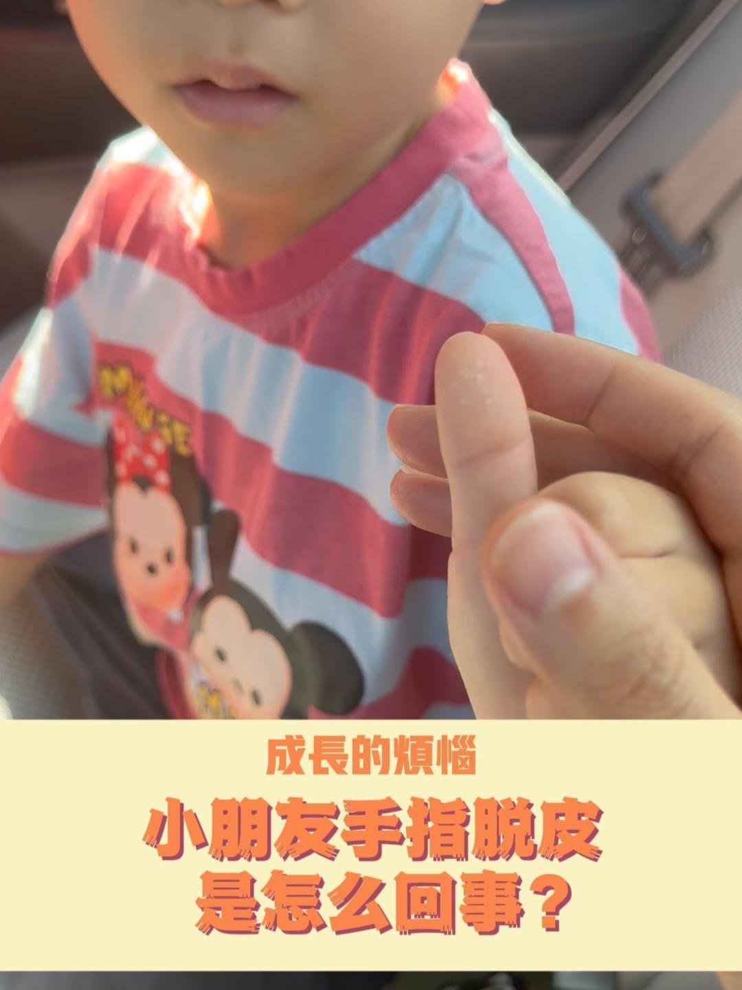 成长的烦恼:小朋友手指脱皮是怎么回事?医学科普 手脱皮 过敏