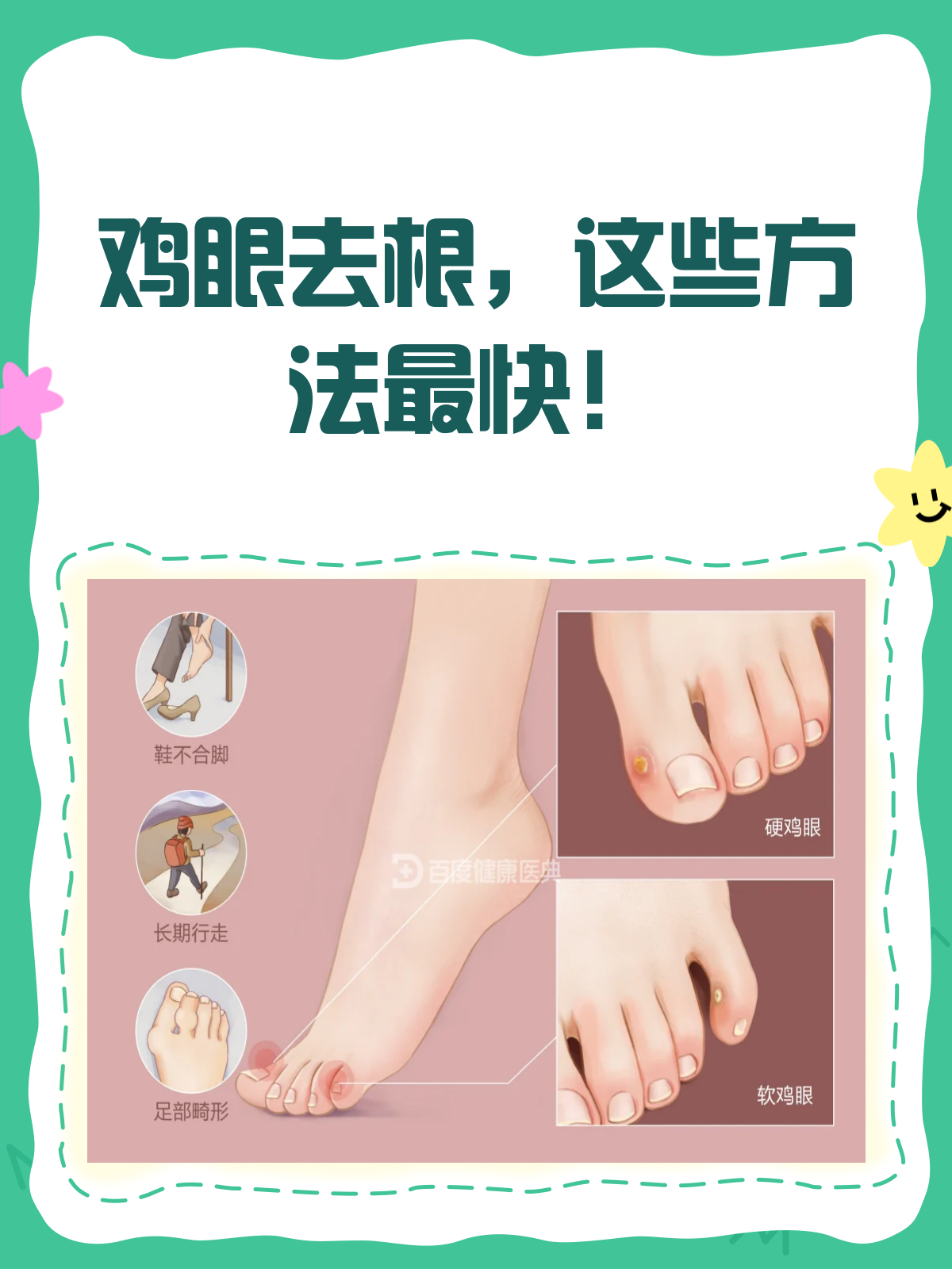 鸡眼去根不再难！这些方法助你快速摆脱