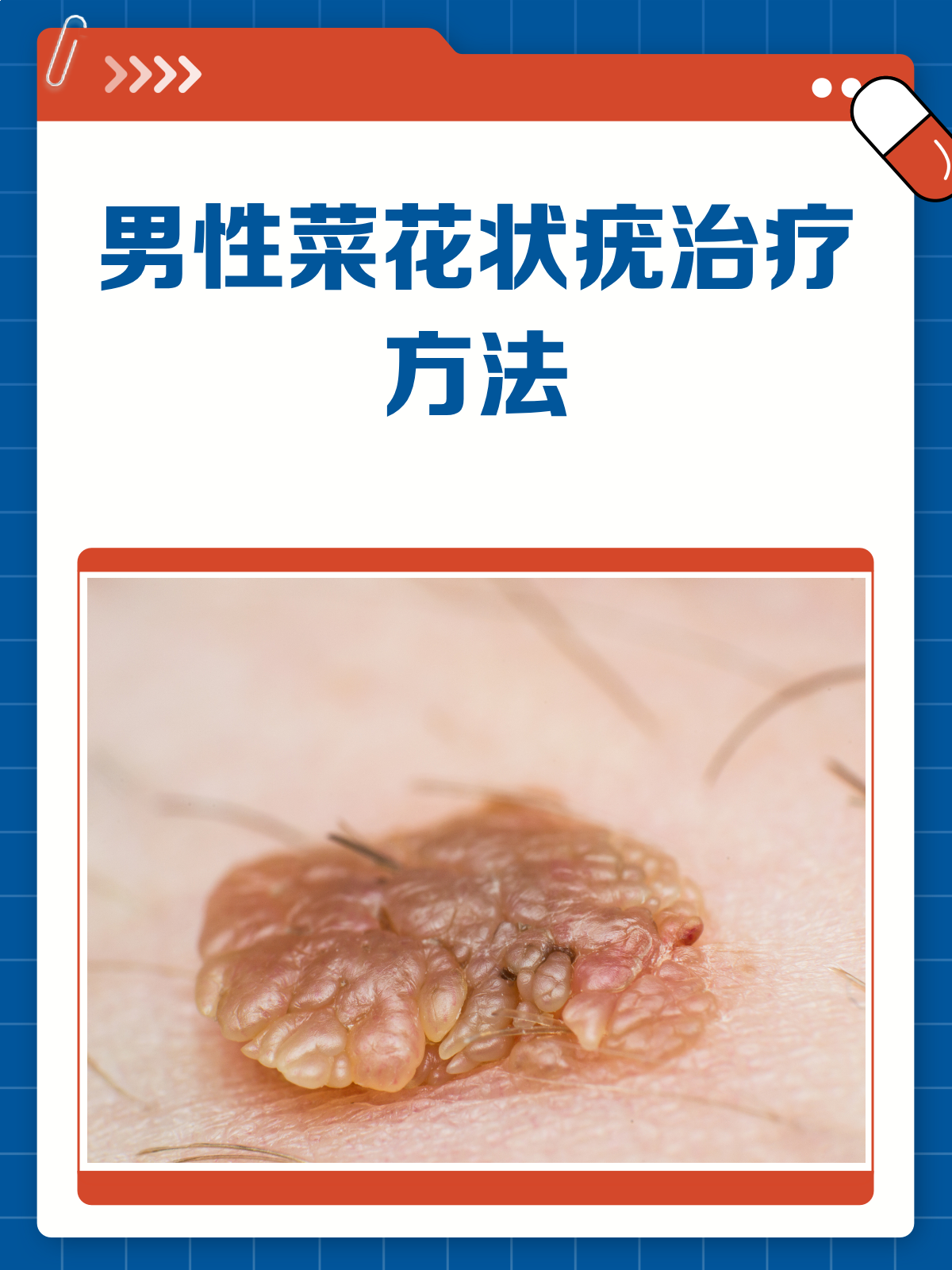 男性菜花状疣怎么办？别急，治疗攻略来啦！