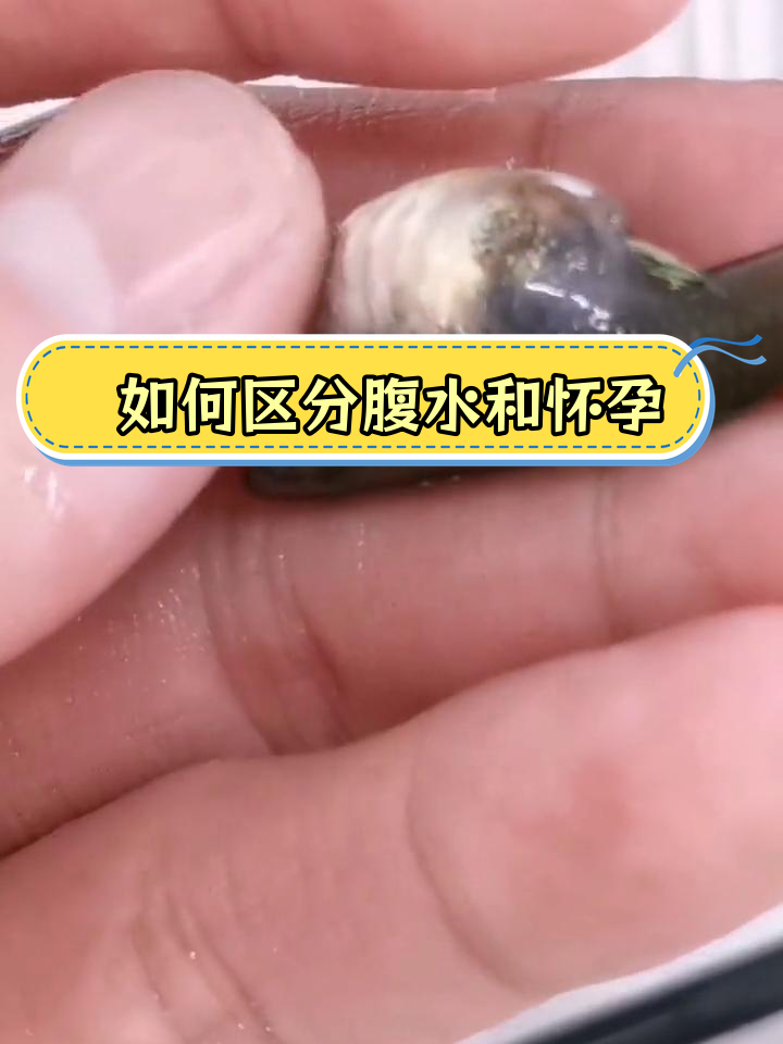 辨别腹水与怀孕,避免误判