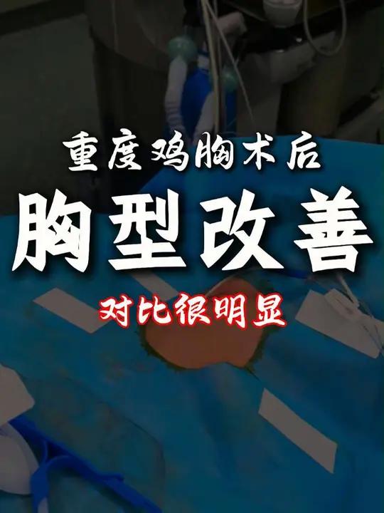 鸡胸手术以后,胸廓有什么变化?鸡胸 鸡胸矫正