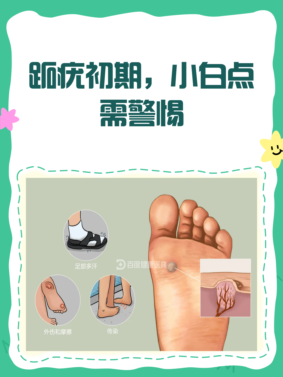 跖疣初期小白点揭秘 看图识别早处理!