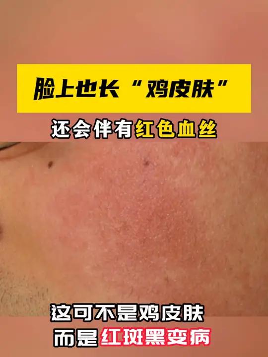 脸上也长“鸡皮肤”