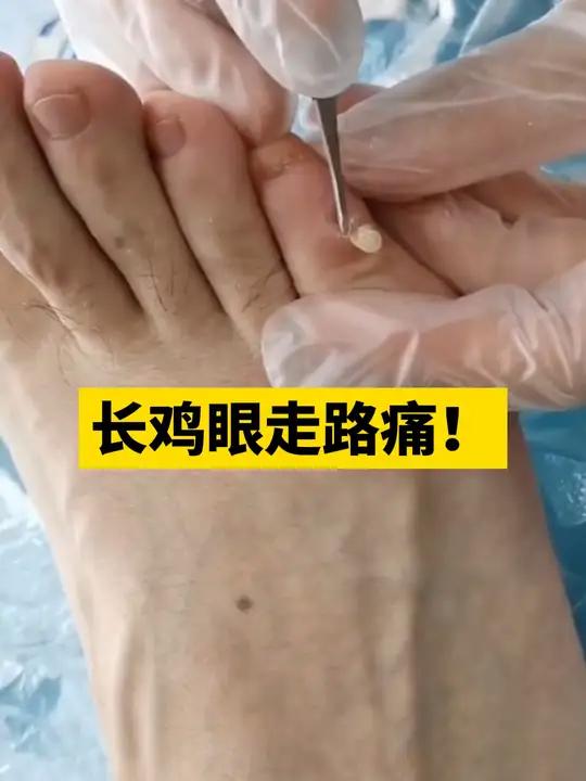 长了鸡眼别去挖!这样处理简单方便