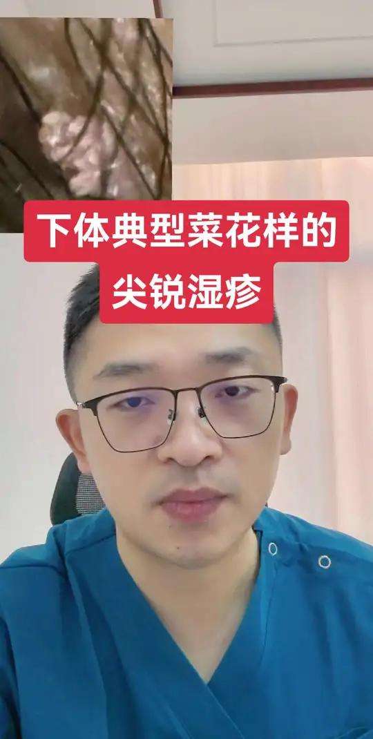 典型的菜花状的尖锐湿疣