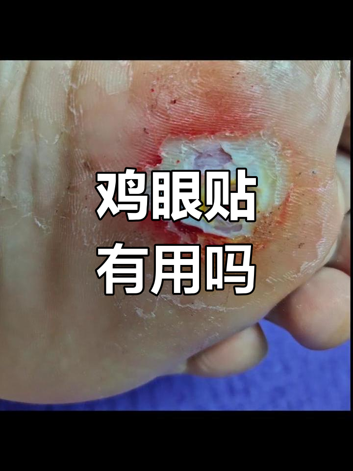 脚底鸡眼贴一周效果不明显,是否继续使用?