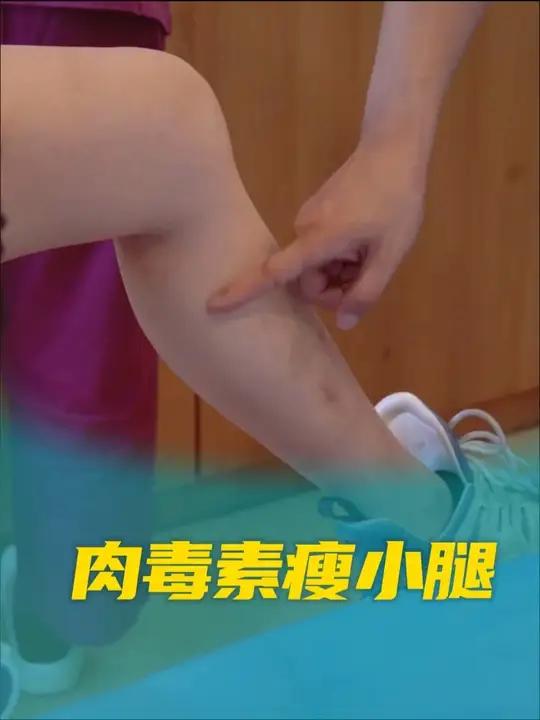 肉毒素瘦小腿 一定要看到最后瘦腿针 肉毒素