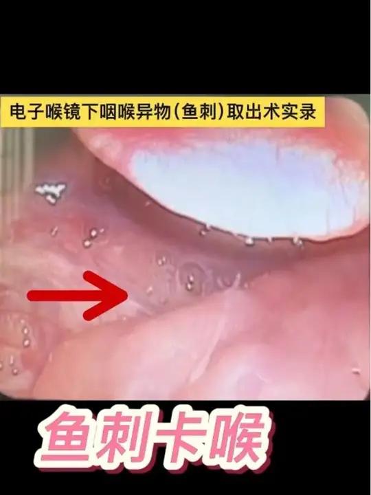 电子喉镜下咽喉异物（鱼刺）取出术实录