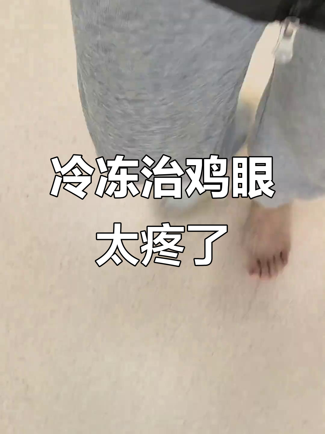 液氮冷冻治疗鸡眼,医生说的5分钟竟然这么夸张!