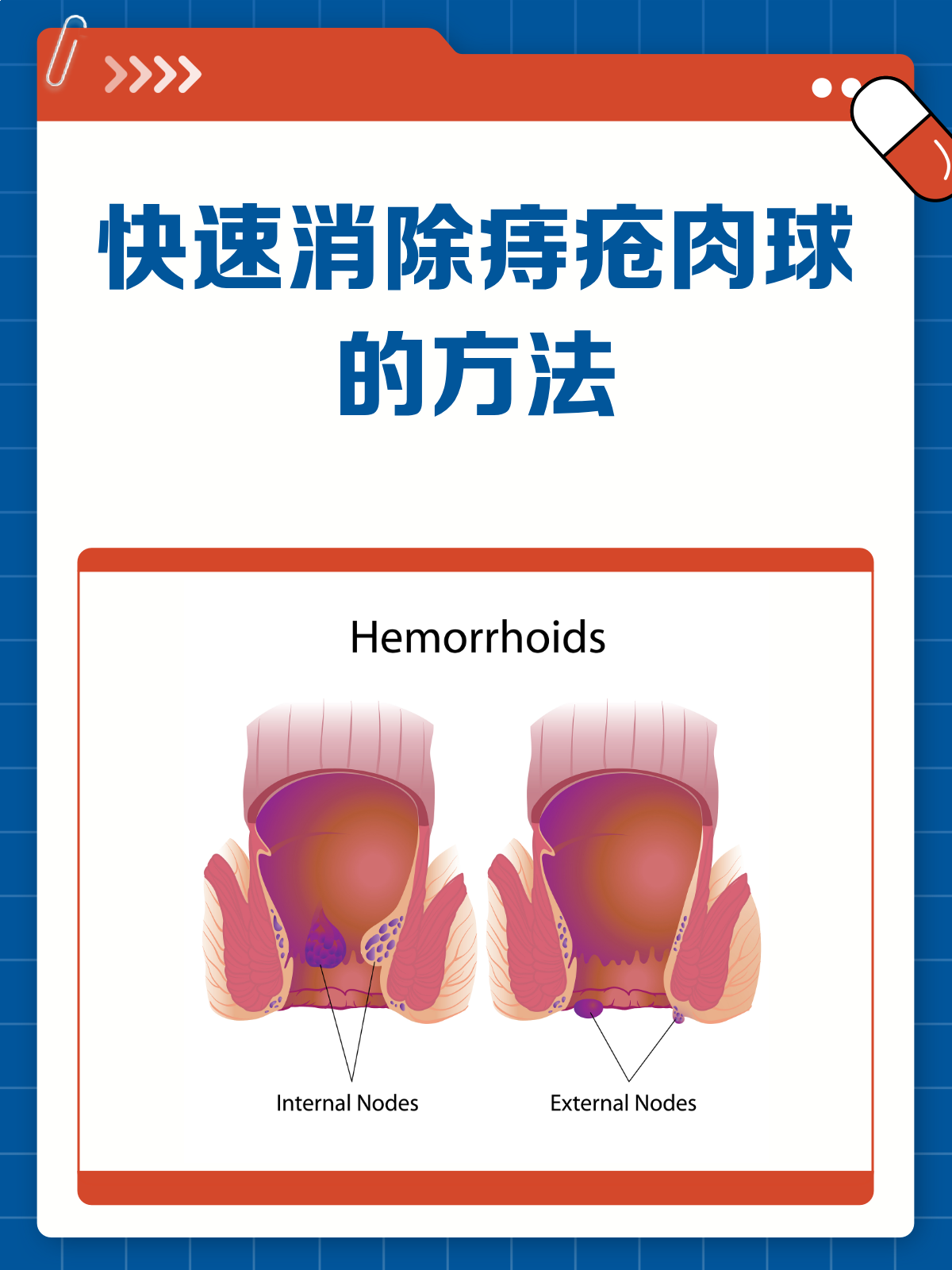 痔疮肉球太烦人？教你几招快速消除它！