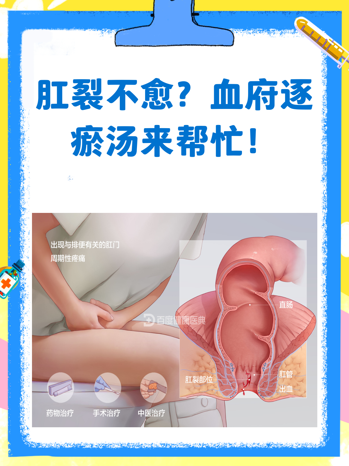肛裂久不愈?血府逐瘀汤加减来帮忙!