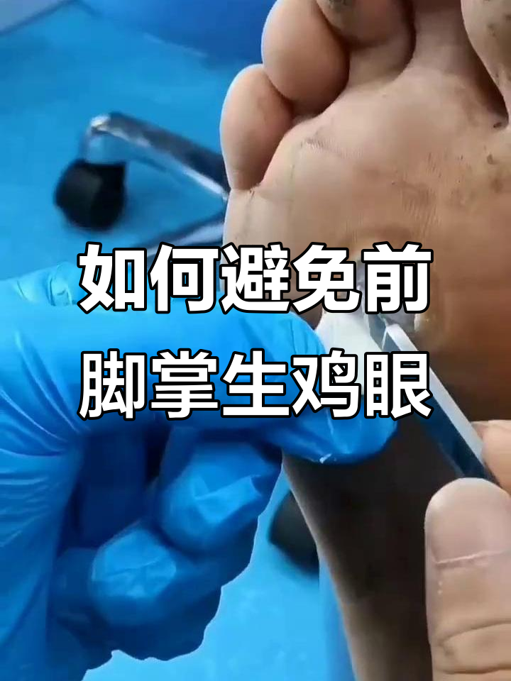 为什么鸡眼总长在前脚掌?教你预防和去除小窍门