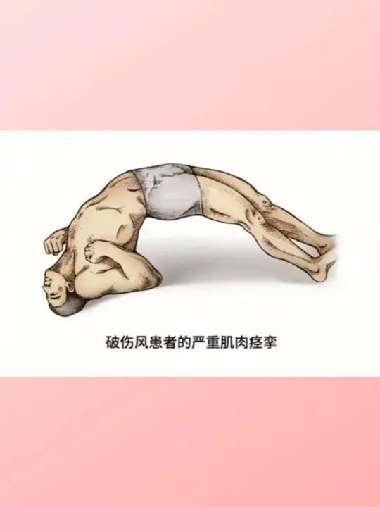 破伤风毒素导致背部肌肉痉挛