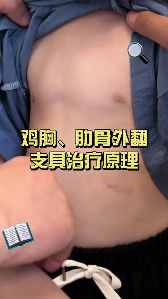 鸡胸、肋骨外翻支具治疗原理