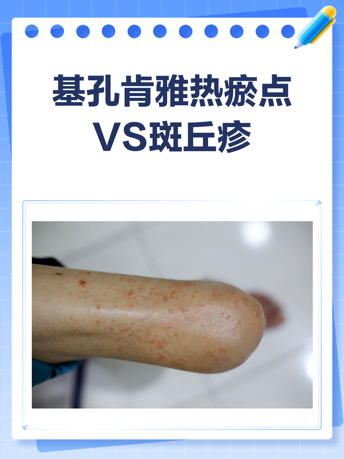 基孔肯雅热vs斑丘疹,一文教你辨清楚!