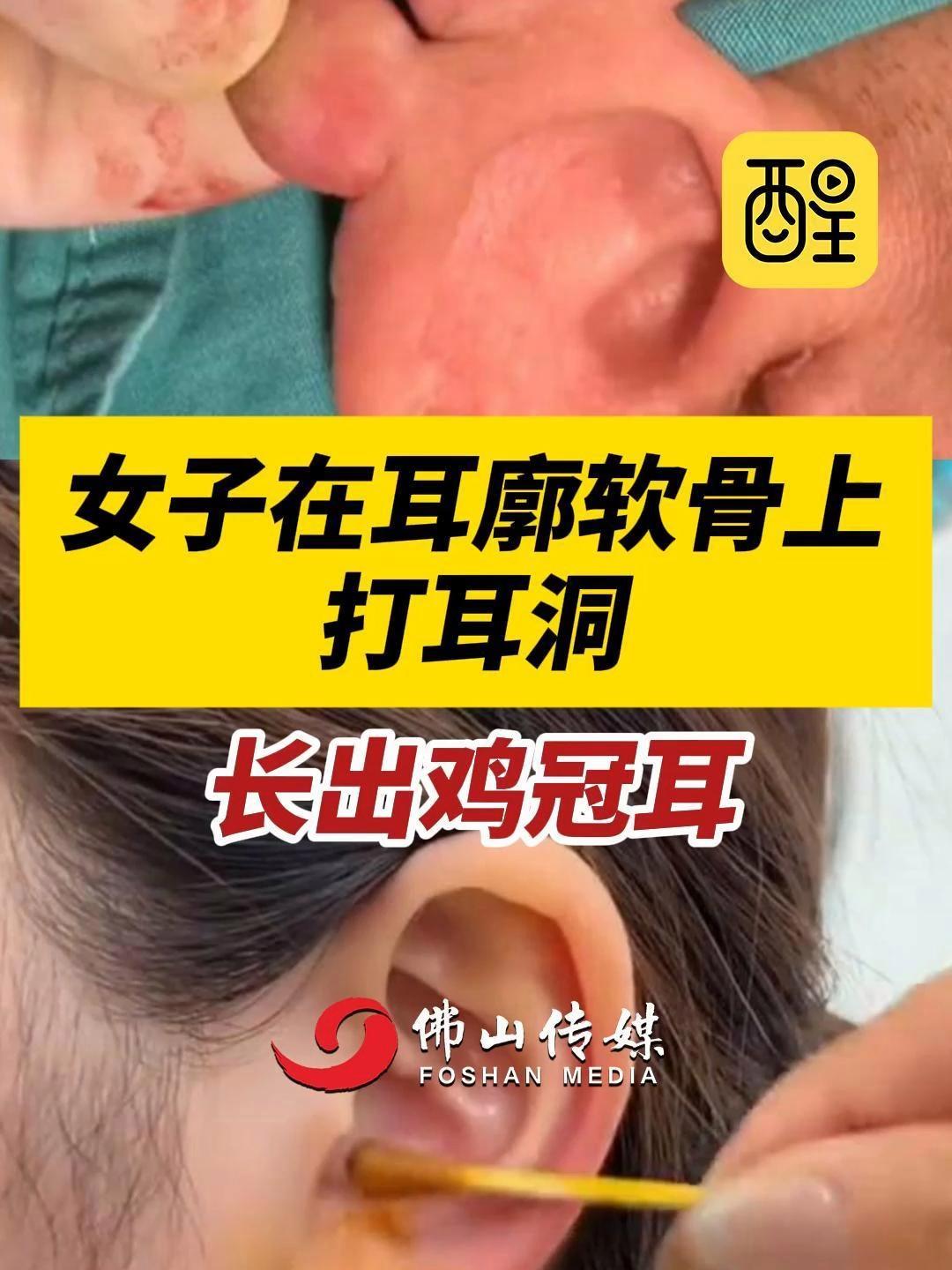 女子在耳廓软骨上打耳洞长出鸡冠耳(编辑:黎晓彤)打耳洞增生疙瘩怎么办 耳洞增生 最新消息 