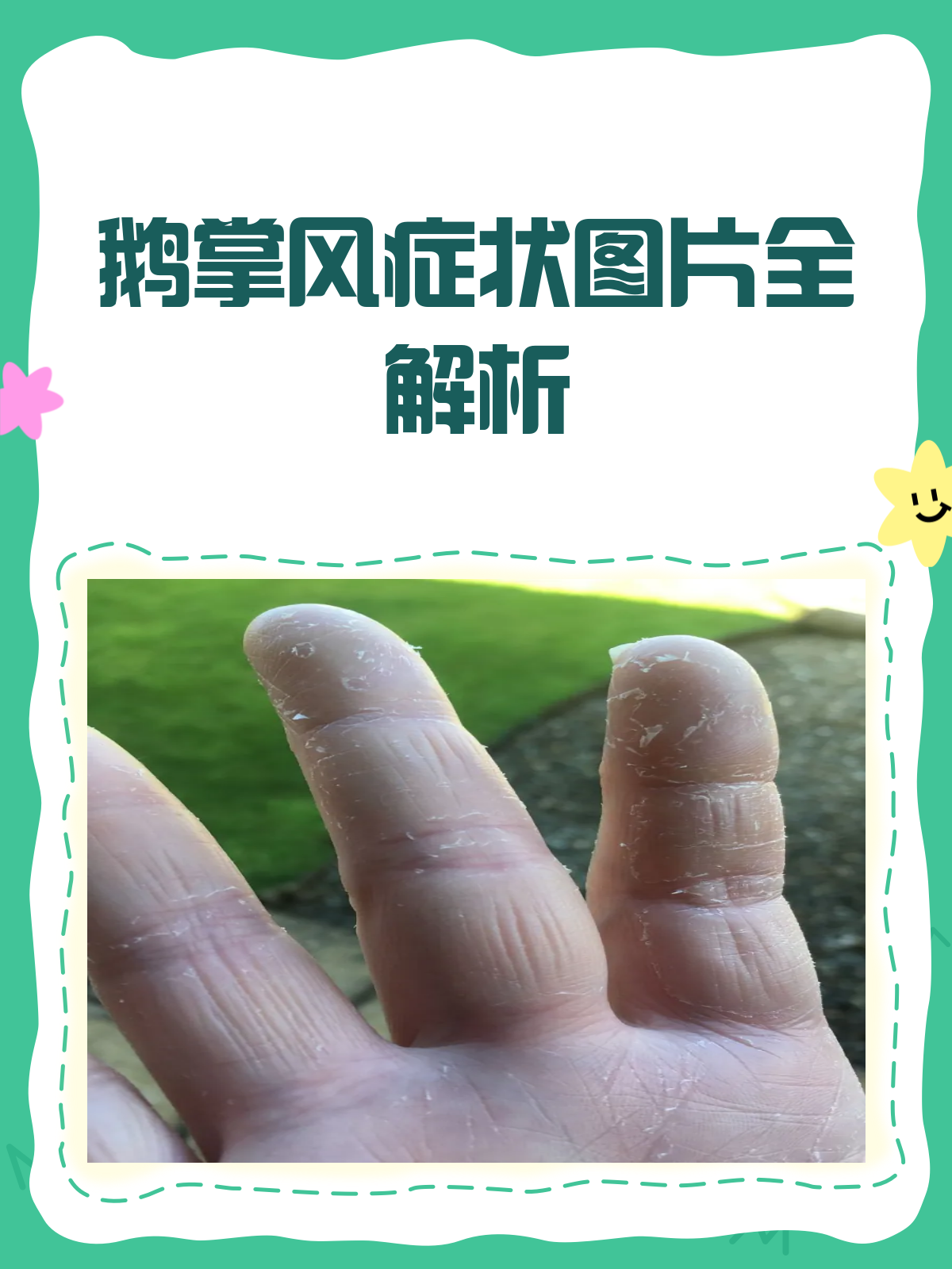 鹅掌风大揭秘!症状图片全解析