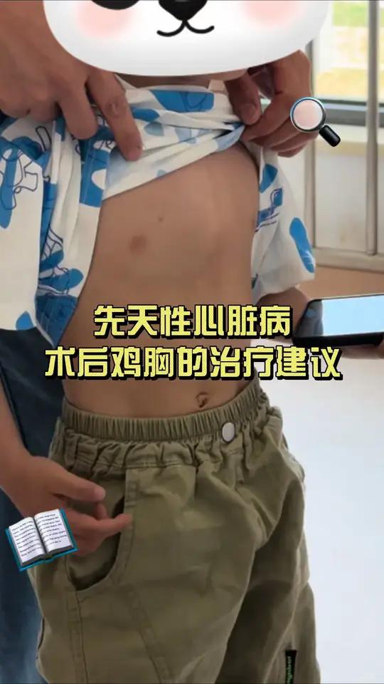 先天性心脏病术后所引起的鸡胸治疗建议