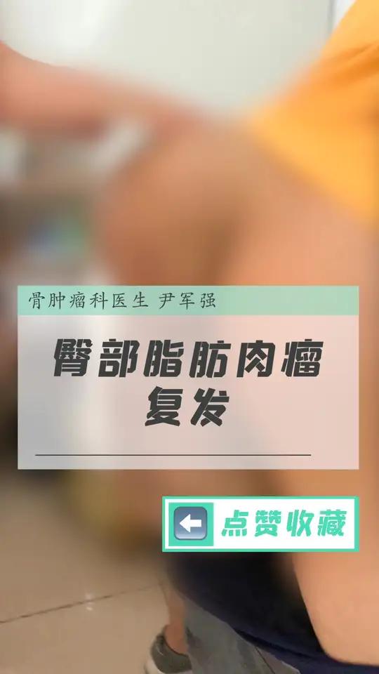 臀部脂肪肉瘤复发,肿瘤越来越大!患者忧心前来问诊!