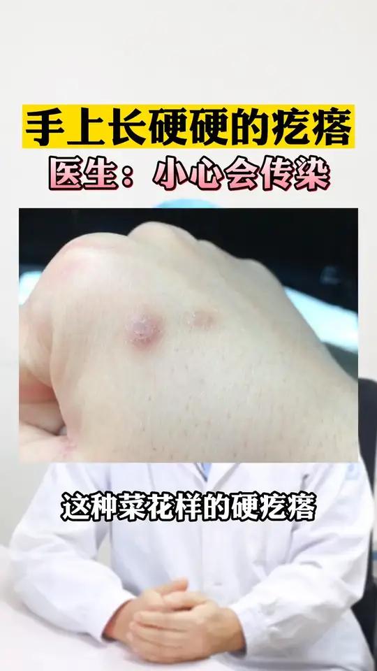 手上长菜花小疙瘩,这可能是寻常疣hpv感染健康科普可以这样处理
