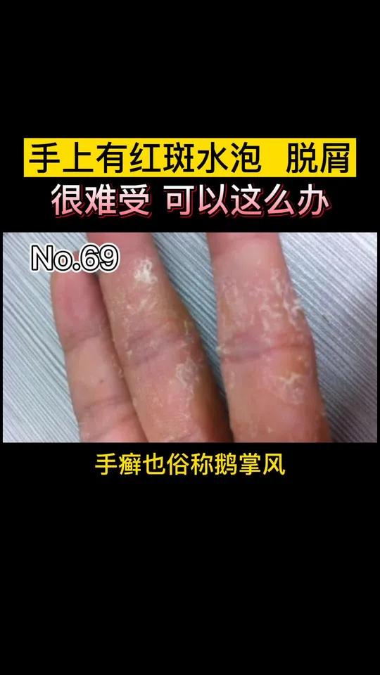 也就是大家常说的鹅掌风,可以这么处理