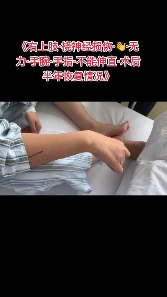 桡神经有很好的恢复!注意避免劳累辛苦今年要高考的学子们?桡神经桡神经损伤桡神经断裂桡神经修