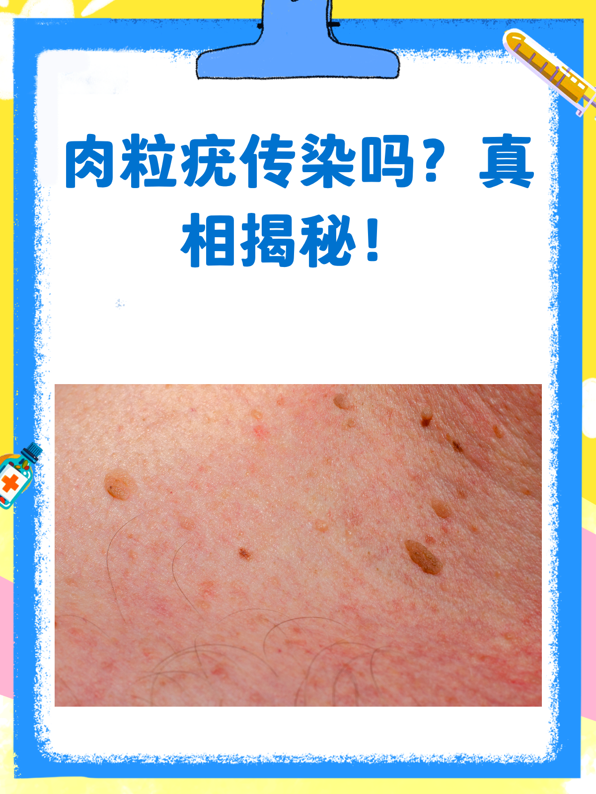 肉粒疣会传染吗?答案在这里!