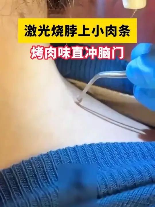 脖子上腋窝下的小肉粒不要用手去揪了