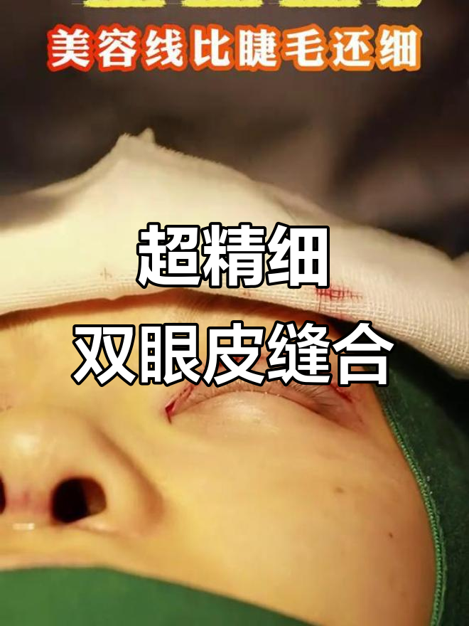 双眼皮精细缝合,美容线比睫毛还细!手术细节揭秘